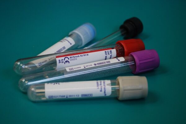 ¿Qué significa el HCM en un análisis de sangre?